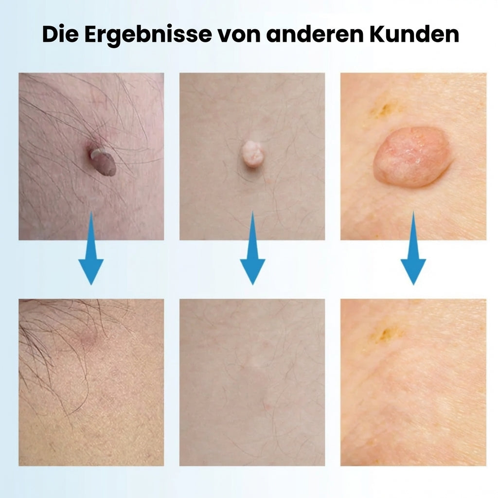 DermaClear™ 2-in-1 Hautanhängsel-Entferner – Glatte Haut ohne Aufwand